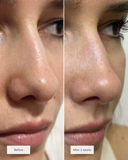 PoreClear™ | Koreaanse Neusporie Reinigingspleisters