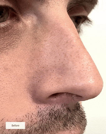 PoreClear™ | Koreaanse Neusporie Reinigingspleisters