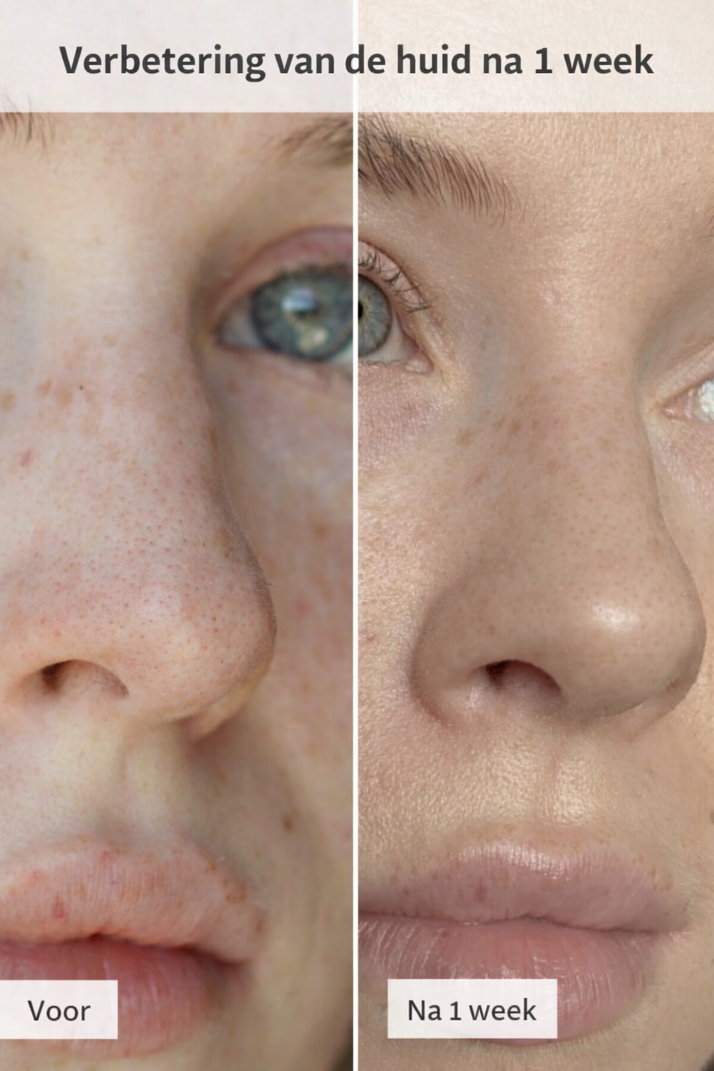 PoreClear™ | Koreaanse Neusporie Reinigingspleisters